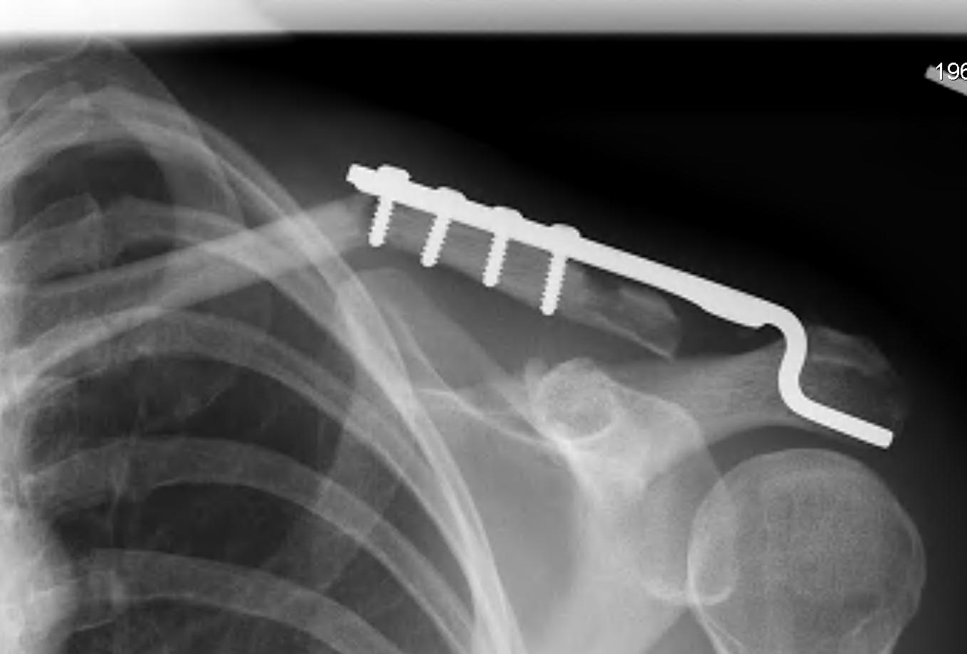 Clavicle Hook Plate Fracture